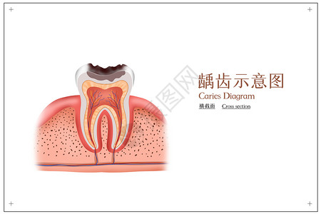 牙科知识龋齿横截面示意图插画
