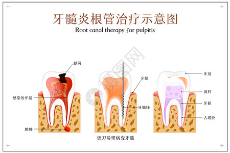 牙齿根管治疗牙髓炎根管治疗示意图插画