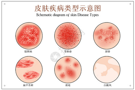 痤疮皮肤病示意图插画