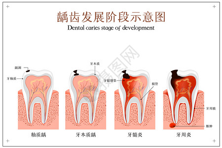显微根管治疗龋齿发展阶段示意图插画