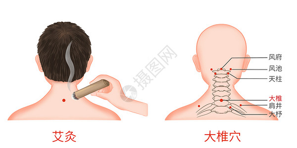 颈椎牵引器颈椎病大椎穴艾灸医疗插画插画