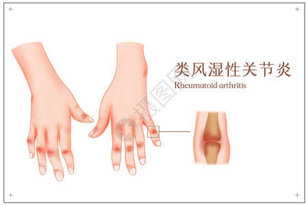 国际关节炎日类风湿性关节炎医疗插画插画