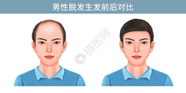 化妆前后对比图男性脱发生发前后对比插画插画