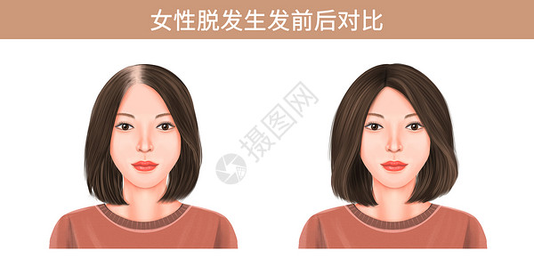 中年女性吃药女性脱发生发前后对比插画插画