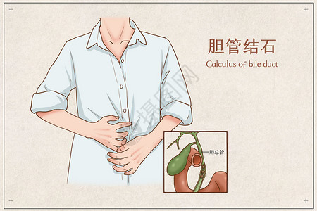 胆管结石医疗插画图片
