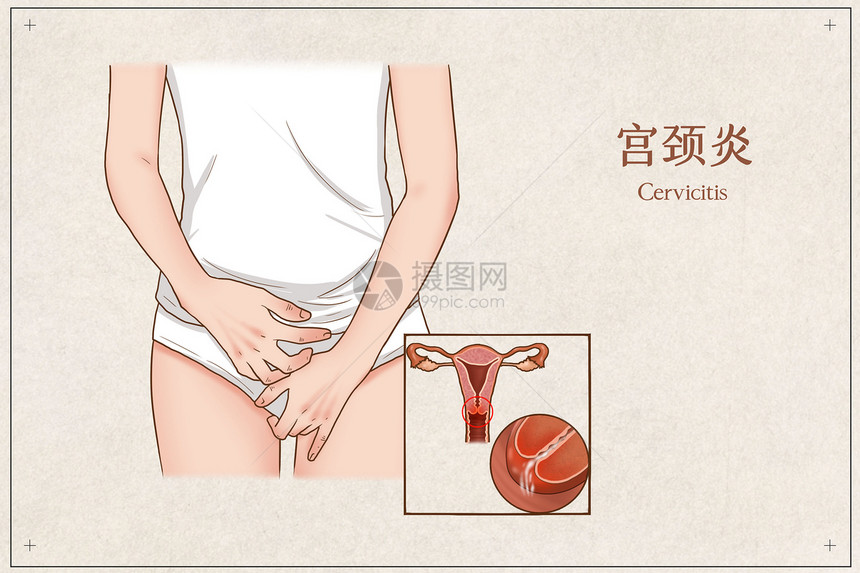 宫颈炎医疗插画图片