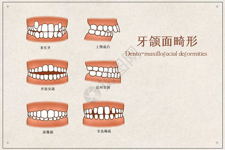牙颌面畸形医疗插画图片