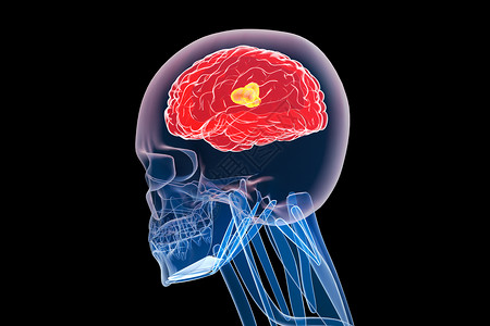 C4D脑部疾病高清图片