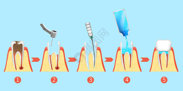 治疗牙齿牙齿根管治疗步骤医疗插画插画