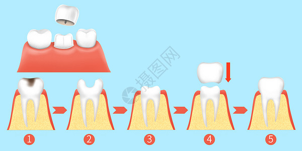 龋齿牙齿烤瓷牙治疗步骤医疗插画插画
