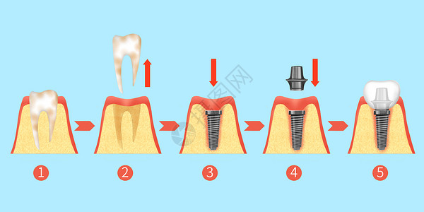 口腔种植牙牙齿种植牙治疗过程步骤医疗插画插画