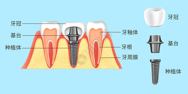 种植牙图解科普医疗插画高清图片