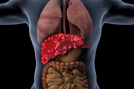 人体肝脏病变设计图片