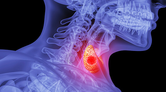 人体甲亢场景高清图片