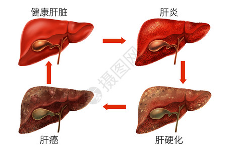乙肝肝脏病变症状医疗插画高清图片