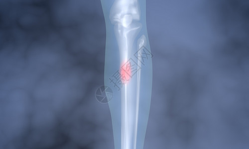 小腿疼痛腿骨骨折设计图片