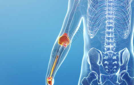 3D手腕关节疾病高清图片