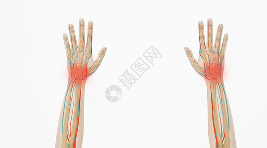 手腕骨骼3D腱鞘炎场景设计图片