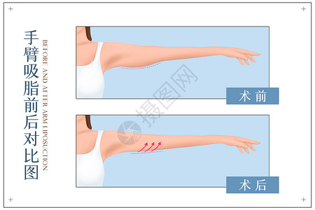 抽脂手术手臂吸脂前手术前后对比示意图插画