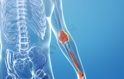 晚期类风湿性人体手臂骨质增生设计图片