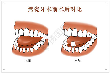 牙齿对比图烤瓷牙术前术后对比口腔医学配图插画