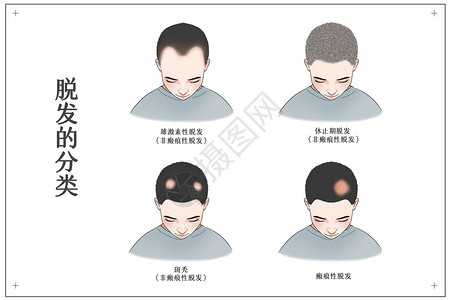 瘢痕疙瘩脱发的分类医疗插画插画