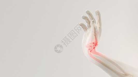 手腕关节3D腱鞘炎场景设计图片