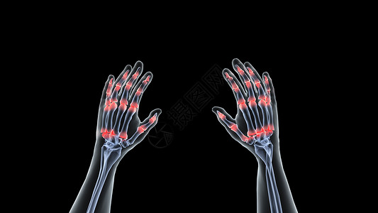 手指受伤出血3D职业病腱鞘炎场景设计图片