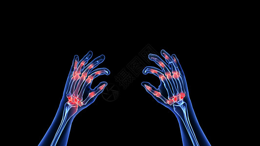 手指有血素材3D职业病腱鞘炎场景设计图片