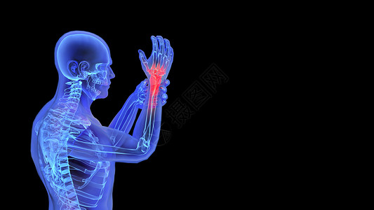 手腕骨骼3D手腕疾病设计图片