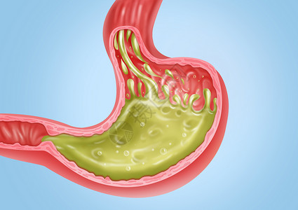 反酸烧心胃反流医疗健康插图插画