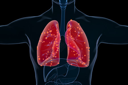 肺部感染病变场景背景图片
