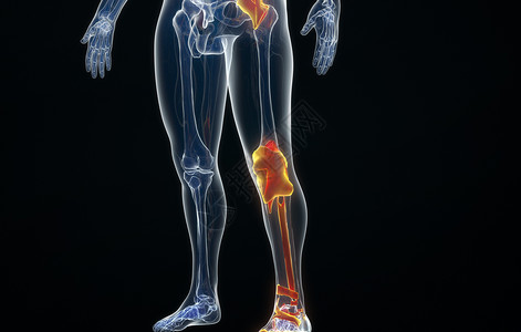 软骨损失3D腿部骨骼半月板设计图片