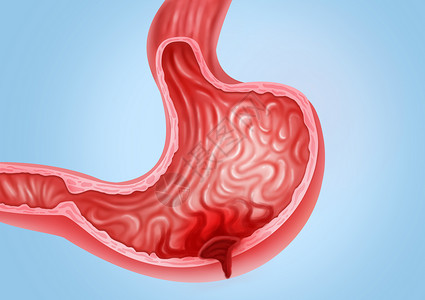 胃穿孔医疗健康插图高清图片