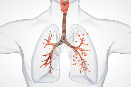 支气管痉挛支气管炎病变场景设计图片