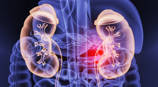 肾盆输尿管3D肾结石场景设计图片