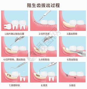 牙痛阻生齿拔出过程医疗插图插画