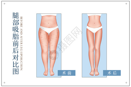 减肥整形大腿吸脂前手术前后对比示意图插画