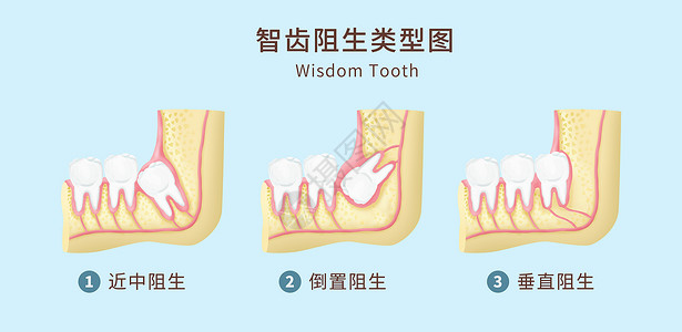 牙痛智齿阻生类型图医疗插图插画