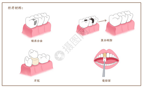 补牙材料口腔医学配图插画