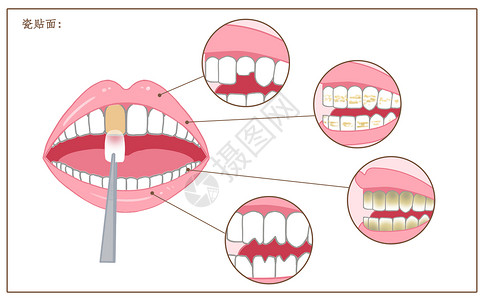 前牙牙齿瓷贴面修复口腔医学配图插画