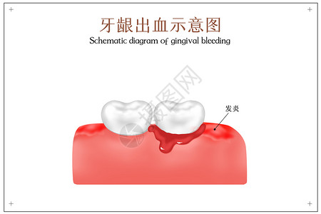 牙龈出血示意图插画