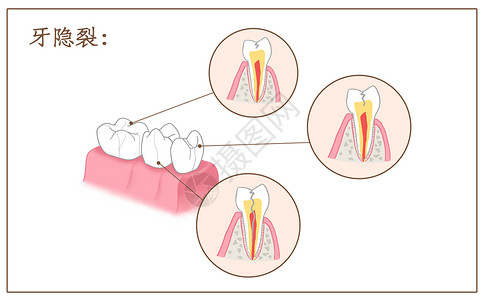 敏感泛红牙齿隐裂口腔医学配图插画
