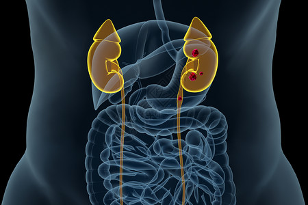 肠道粘膜肾结石病变场景设计图片
