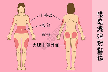 女性患者腰疼糖尿病患者胰岛素注射部位插画