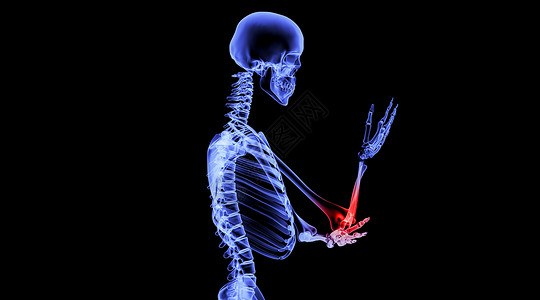 左肱骨人体网球肘场景设计图片