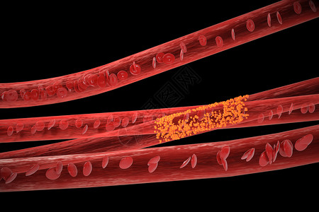 饱和脂肪心血管病变场景设计图片