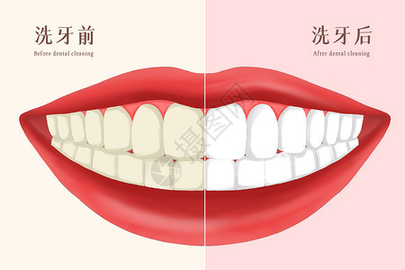 一张白低素材牙齿美容之洗牙前后对比插画插画