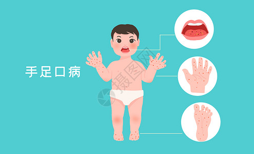 传染病防治儿童手足口病插画
