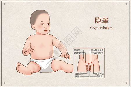 隐睾医疗插画图片